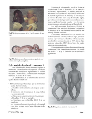 Ejemplos de enfermedades recesivas ligadas al
                                                             cromosoma X son la hemofilia A, la displasia
                                                             ectodérmica hipohidrótica y la distrofia muscular de
                                                             Duchenne. Se ha descrito una alteración del cromosoma
                                                             X, llamada fragilidad del X, donde hay un sitio frágil en
                                                             el extremo distal del brazo largo de este ( fra Xq28),
                                                             que clínicamente da lugar a retraso mental marcado y
                                                             macroorquidismo lenguaje peculiar y con frecuencia,
                                                             comportamiento autista (síndrome de Martín Bell).
                                                                   Las enfermedades dominantes ligadas al
                                                             cromosoma X son muy poco frecuentes. Las ocasiona
                                                             la presencia de un gen dominante situado en el X. Va-
Fig.27.6. Albinismo en uno de los 2 recién nacidos de raza   rones y hembras enferman.
negra.                                                             Los hombres enfermos casados con mujeres nor-
                                                             males trasmiten el carácter a todas sus hijas, pero nun-
                                                             ca a sus hijos varones. Las hembras enfermas casadas
                                                             con hombres normales tendrán el 50 % de sus hijas
                                                             enfermas y, también, el 50 % de sus hijos. Hay predo-
                                                             minio de mujeres enfermas.
                                                                   Ejemplos de enfermedades dominantes ligadas al
                                                             cromosoma X son el raquitismo resistente a la vitami-
                                                             na D (Fig. 27.8) y el síndrome de incontinencia
                                                             pigmentaria.


Fig. 27.7. Lesiones ampollares rotas en un paciente con
porfiria eritropoyética congénita.


Enfermedades ligadas al cromosoma X
     Estas enfermedades pueden heredarse: ligadas al
cromosoma X de modo recesivo y ligadas al X de modo
dominante. En ambos casos, el gen anormal se sitúa en
uno de los 2 cromosomas X si se trata de una mujer y en
el único X en el caso de un varón.
     Las características de las enfermedades recesivas
ligadas al cromosoma X son:

• El tener una mayor frecuencia que las dominantes
   ligadas al cromosoma X.
• Los hombres son los enfermos y las mujeres las por-
   tadoras.
• El matrimonio más frecuente es el de una portadora
   y un hombre normal.
• Los hijos varones de este matrimonio tienen una pro-
  babilidad del 50 % de ser afectados.
• Las hijas tienen una probabilidad del 50 % de ser
  portadoras.
• Los varones enfermos no trasmiten la enfermedad
  a sus hijos varones, pero sí a sus hijas, que serán        Fig. 27. 8. Raquitismo resistente a la vitamina D.
  portadoras.

                   280                                                                                            Tomo I
 