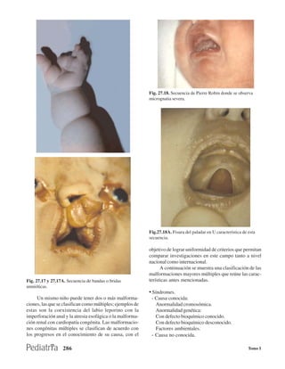 Fig. 27.18. Secuencia de Pierre Robin donde se observa
                                                            micrognatia severa.




                                                            Fig.27.18A. Fisura del paladar en U característica de esta
                                                            secuencia.

                                                            objetivo de lograr uniformidad de criterios que permitan
                                                            comparar investigaciones en este campo tanto a nivel
                                                            nacional como internacional.
                                                                  A continuación se muestra una clasificación de las
                                                            malformaciones mayores múltiples que reúne las carac-
Fig. 27.17 y 27.17A. Secuencia de bandas o bridas           terísticas antes mencionadas.
amnióticas.
                                                            • Síndromes.
     Un mismo niño puede tener dos o más malforma-           - Causa conocida:
ciones, las que se clasifican como múltiples; ejemplos de      Anormalidad cromosómica.
estas son la coexistencia del labio leporino con la            Anormalidad genética:
imperforación anal y la atresia esofágica o la malforma-       Con defecto bioquímico conocido.
ción renal con cardiopatía congénita. Las malformacio-         Con defecto bioquímico desconocido.
nes congénitas múltiples se clasifican de acuerdo con          Factores ambientales.
los progresos en el conocimiento de su causa, con el         - Causa no conocida.

                  286                                                                                             Tomo I
 