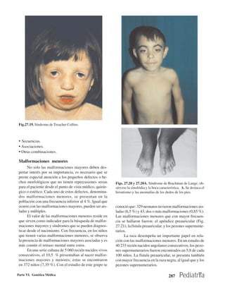 Fig.27.19. Síndrome de Treacher Collins.



 • Secuencias.
 • Asociaciones.
 • Otras combinaciones.

 Malformaciones menores
       No solo las malformaciones mayores deben des-
 pertar interés por su importancia, es necesario que se
 preste especial atención a los pequeños defectos o he-
 chos morfológicos que no tienen repercusiones serias       Figs. 27.20 y 27.20A. Síndrome de Brachman de Lange, ob-
 para el paciente desde el punto de vista médico, quirúr-   sérvese la sinofridia y la boca característica. A. Se destaca el
 gico o estético. Cada uno de estos defectos, denomina-     hirsutismo y las anomalías de los dedos de los pies.
 dos malformaciones menores, se presentan en la
 población con una frecuencia inferior al 4 %. Igual que
 ocurre con las malformacioncs mayores, pueden ser ais-     conoció que: 329 neonatos tuvieron malformaciones ais-
 ladas y múltiples.                                         ladas (6,5 %) y 43, dos o más malformaciones (0,85 %).
       El valor de las malformaciones menores reside en     Las malformaciones menores que con mayor frecuen-
 que sirven como indicador para la búsqueda de malfor-      cia se hallaron fueron: el apéndice preauricular (Fig.
 maciones mayores y síndromes que se pueden diagnos-        27.21), la fístula preauricular, y los pezones supernume-
 ticar desde el nacimiento. Con frecuencia, en los niños    rarios.
 que tienen varias malformaciones menores, se observa            La raza desempeña un importante papel en rela-
 la presencia de malformaciones mayores asociadas y es      ción con las malformaciones menores. En un estudio de
 más común el retraso mental entre estos.                   40 233 recién nacidos angolanos consecutivos, los pezo-
       En una serie cubana de 5 060 recién nacidos vivos    nes supernumerarios fueron encontrados en 5,8 de cada
 consecutivos, el 10,5 % presentaban al nacer malfor-       100 niños. La fístula preauricular, se presenta también
 maciones mayores y menores; estas se encontraron           con mayor frecuencia en la raza negra, al igual que y los
 en 372 niños (7,35 %). Con el estudio de este grupo se     pezones supernumerarios.

Parte VI. Genética Médica                                                                         287
 