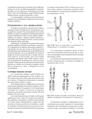 A menudo hay alteraciones de la mano en los síndromes         en 2 partes o brazos (Fig.27.30): p, el brazo corto y q, el
 genéticos y en tal caso habrá dermatoglifos anormales;        brazo largo. Algunos cromosomas presentan zonas
 ejemplos son los síndromes de Brachman de Lange               heterocromáticas o constricciones secundarias, como en
 (Fig. 27.20 y 20 A) Rubinstein- Taybi; Pfeiffer, Poland,      los cromosomas 1, 9 y 16.
 Saethre-Chotzen, enanismo diastrófico, y otros.
      Los dermatoglifos constituyen un instrumento de
 trabajo de gran utilidad para el diagnóstico de las enfer-
 medades genéticas.

 CROMOSOMAS Y SUS ABERRACIONES
       El análisis cromosómico constitucional se obtiene
 mediante el cultivo de linfocitos de una muestra de san-
 gre periférica, durante 72 h como promedio. Este cultivo
 también, se realiza en médula ósea obtenida por punción
 esternal, fibroblastos de piel o fascias, hígado, células .
 malignas de tumores, esperma, líquido amniótico y
 vellosidad corial. El tiempo de cultivo varía de acuerdo
 con el tipo de células cultivadas.
       Inicialmente, el estudio de los cromosomas en una
 metafase mediante coloración con Giemsa, solo permi-          Fig. 27.30. Tipos de cromosomas: A, metacéntrico. B,
 tía el diagnóstico de algunas alteraciones numéricas y        submetacéntrico. C, acrocéntrico con satélite.
 estructurales de estos, por lo que se buscaron nuevos
 procedimientos que permitieron una mejor identificación            Los cromosomas acrocéntricos tienen un brazo
 de cada cromosoma. Así, en la década de los sesenta, el       corto en el extremo del cual hay un tallo que se conti-
 empleo de técnicas especiales para su estudio, hizo po-       núa con una pequeña masa redonda de hetecocromatina
 sible observar al microscopio, que estos estaban              denominada satélite.
 constituídos por bandas transversales oscuras y claras,            Las técnicas de bandas permiten identificar los di-
 con una disposición característica en cada uno, lo que        ferentes cromosomas por sus patrones de bandas ca-
 permitió la observación de aberraciones cromosómicas          racterísticas (Fig. 27.31).
 parciales no visibles con las técnicas corrientes y abrió
 nuevas perspectivas para el diagnóstico de las
 cromosopatías.

 Cariotipo humano normal
       Los cromosomas humanos están formados por
 ADN ( ácido desoxirribonucleico). Solo se hacen visi-
 bles durante la división celular, tanto en la mitosis como
 en la meiosis. El número de cromosomas es constante
 para cada especie animal o vegetal .
       El ser humano tiene un complemento cromosómico
 de 46 (número diploide) en las células somáticas y de 23
 (número haploide) en los gametos. Los 46 cromosomas
 se dividen en 23 pares: 22 pares de cromosomas
 autosomas y un par de cromosomas sexuales, XX en la
 hembra y XY en el varón.
       Los cromosomas humanos normales se distinguen           Fig. 27.31. Esquema de bandas cromosómicas (técnica de
 también por ser de 3 tipos, de acuerdo con la posición        tripsina): A. cromosoma 1. B, cromosoma 4. C, cromosoma 21.
 del centrómero: metacéntricos, cuando este está situado
 en la parte media; submetacéntrico, cuando está más                Se denomina cariotipo al ordenamiento de los
 cerca de un extremo que del otro; acrocéntrico, cuando        cromosomas por parejas siguiendo la nomenclatura
 el centrómero está aún más próximo a uno de los extre-        citogenética. En el cariotipo los cromosomas se clasifi-
 mos del cromosoma. El centrómero divide al cromosoma          can por el orden decreciente de tamaño y la posición

Parte VI. Genética Médica                                                                         295
 