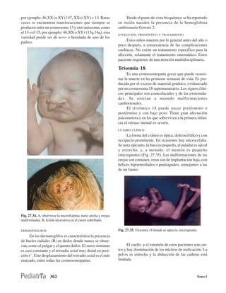 por ejemplo: 46,XX (o XY) / 47, XX(o XY) + 13. Raras                  Desde el punto de vista bioquímico se ha reportado
veces se encuentran translocaciones que siempre se               en recién nacidos la presencia de la hemoglobina
producen entre un cromosoma 13 y otro autosoma, como             embrionaria Gowers 2.
el 14 o el 15, por ejemplo: 46,XX o XY t (13q 14q); esta
                                                                 EVOLUCIÓN, PRONÓSTICO Y TRATAMIENTO
variedad puede ser de novo o heredada de uno de los
                                                                      Estos niños mueren por lo general antes del año o
padres.
                                                                 poco después, a consecuencia de las complicaciones
                                                                 cardíacas. No existe un tratamiento específico para la
                                                                 afección, solamente el tratamiento sintomático. Estos
                                                                 paciente requieren de una atención multidisciplinaria.

                                                                 Trisomía 18
                                                                       Es una cromosomopatía grave que puede ocasio-
                                                                 nar la muerte en las primeras semanas de vida. Es pro-
                                                                 ducida por el exceso de material genético, evidenciado
                                                                 por un cromosoma 18 supernumerario. Los signos clíni-
                                                                 cos principales son craneofaciales y de las extremida-
                                                                 des. Se asocian a menudo malformaciones
                                                                 cardiorrenales.
                                                                       El trisómico 18 puede nacer pretérmino o
                                                                 postérmino y con bajo peso. Tiene gran afectación
                                                                 psicomotora y en los que sobreviven a la primera infan-
                                                                 cia el retraso mental es severo.
                                                                 CUADRO CLÍNICO
                                                                      La forma del cráneo es típica, dolicocefálico y con
                                                                 occipucio prominente. En ocasiones hay microcefalia.
                                                                 Se nota epicanto, la boca es pequeña, el paladar es ojival
                                                                 y estrecho, y, a menudo, el mentón es pequeño
                                                                 (micrognatia) (Fig. 27.35). Las malformaciones de las
                                                                 orejas son comunes; estas son de implantación baja, con
                                                                 hélices hipoenrollados o puntiagudos, semejantes a las
                                                                 de un fauno.




Fig. 27.34. A, obsérvese la microftalmia, nariz ancha y orejas
malformadas. B, lesión ulcerativa en el cuero cabelludo.

DERMATOGLIFOS                                                    Fig. 27.35. Trisomia 18 donde se aprecia micrognatia.
      En los dermatoglifos es característica la presencia
de bucles radiales (R) en dedos donde nunca se obser-
van, como el pulgar y el quinto dedos. El surco simiamo                El cuello y el esternón de estos pacientes son cor-
es casi constante y el trirradio axial muy distal en posi-       tos y hay disminución de los núcleos de osificación. La
ción t'''. Este desplazamiento del trirradio axial es el más     pelvis es estrecha y la abducción de las caderas está
marcado, entre todas las cromosomopatías.                        limitada.



                    302                                                                                              Tomo I
 