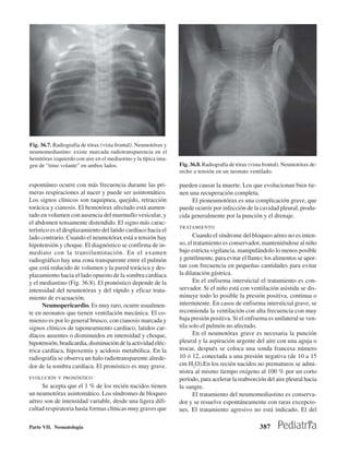 Fig. 36.7. Radiografía de tórax (vista frontal). Neumotórax y
neumomediastino: existe marcada radiotransparencia en el
hemitórax izquierdo con aire en el mediastino y la típica ima-
gen de “timo volante” en ambos lados.                            Fig. 36.8. Radiografía de tórax (vista frontal). Neumotórax de-
                                                                 recho a tensión en un neonato ventilado.

espontáneo ocurre con más frecuencia durante las pri-            pueden causar la muerte. Los que evolucionan bien tie-
meras respiraciones al nacer y puede ser asintomático.           nen una recuperación completa.
Los signos clínicos son taquipnea, quejido, retracción                El pioneumotórax es una complicación grave, que
torácica y cianosis. El hemotórax afectado está aumen-           puede ocurrir por infección de la cavidad pleural, produ-
tado en volumen con ausencia del murmullo vesicular, y           cida generalmente por la punción y el drenaje.
el abdomen tensamente distendido. El signo más carac-
                                                                 TRATAMIENTO
terístico es el desplazamiento del latido cardíaco hacia el
lado contrario. Cuando el neumotórax está a tensión hay                Cuando el síndrome del bloqueo aéreo no es inten-
hipotensión y choque. El diagnóstico se confirma de in-          so, el tratamiento es conservador, manteniéndose al niño
mediato con la transiluminación. En el examen                    bajo estricta vigilancia, manipulándolo lo menos posible
radiográfico hay una zona transparente entre el pulmón           y gentilmente, para evitar el llanto; los alimentos se apor-
que está reducido de volumen y la pared torácica y des-          tan con frecuencia en pequeñas cantidades para evitar
plazamiento hacia el lado opuesto de la sombra cardíaca          la dilatación gástrica.
y el mediastino (Fig. 36.8). El pronóstico depende de la               En el enfisema intersticial el tratamiento es con-
intensidad del neumotórax y del rápido y eficaz trata-           servador. Si el niño está con ventilación asistida se dis-
miento de evacuación.                                            minuye todo lo posible la presión positiva, continua o
      Neumopericardio. Es muy raro, ocurre usualmen-             intermitente. En casos de enfisema intersticial grave, se
te en neonatos que tienen ventilación mecánica. El co-           recomienda la ventilación con alta frecuencia con muy
mienzo es por lo general brusco, con cianosis marcada y          baja presión positiva. Si el enfisema es unilateral se ven-
signos clínicos de taponeamiento cardíaco, latidos car-          tila solo el pulmón no afectado.
díacos ausentes o disminuidos en intensidad y choque,                  En el neumotórax grave es necesaria la punción
hipotensión, bradicardia, disminución de la actividad eléc-      pleural y la aspiración urgente del aire con una aguja o
trica cardíaca, hipoxemia y acidosis metabólica. En la           trocar, después se coloca una sonda francesa número
radiografía se observa un halo radiotransparente alrede-         10 ó 12, conectada a una presión negativa (de 10 a 15
dor de la sombra cardíaca. El pronóstico es muy grave.           cm H2O).En los recién nacidos no prematuros se admi-
                                                                 nistra al mismo tiempo oxígeno al 100 % por un corto
EVOLUCIÓN Y PRONÓSTICO                                           período, para acelerar la reabsorción del aire pleural hacia
     Se acepta que el 1 % de los recién nacidos tienen           la sangre.
un neumotórax asintomático. Los síndromes de bloqueo                   El tratamiento del neumomediastino es conserva-
aéreo son de intensidad variable, desde una ligera difi-         dor y se resuelve espontáneamente con raras excepcio-
cultad respiratoria hasta formas clínicas muy graves que         nes. El tratamiento agresivo no está indicado. El del

Parte VII. Neonatología                                                                              387
 