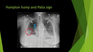 02 Pulmonary Embolism diagnosis treatment.pptx