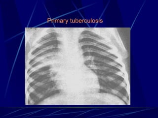Pulmonary Tuberculosis and its presentationss.ppt