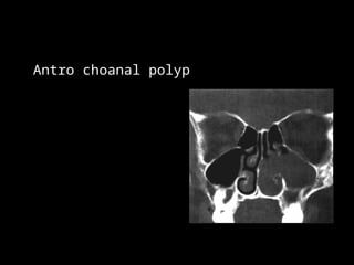 02 Radiology of nose and pns.PPT Dr alakwa amran | PPT