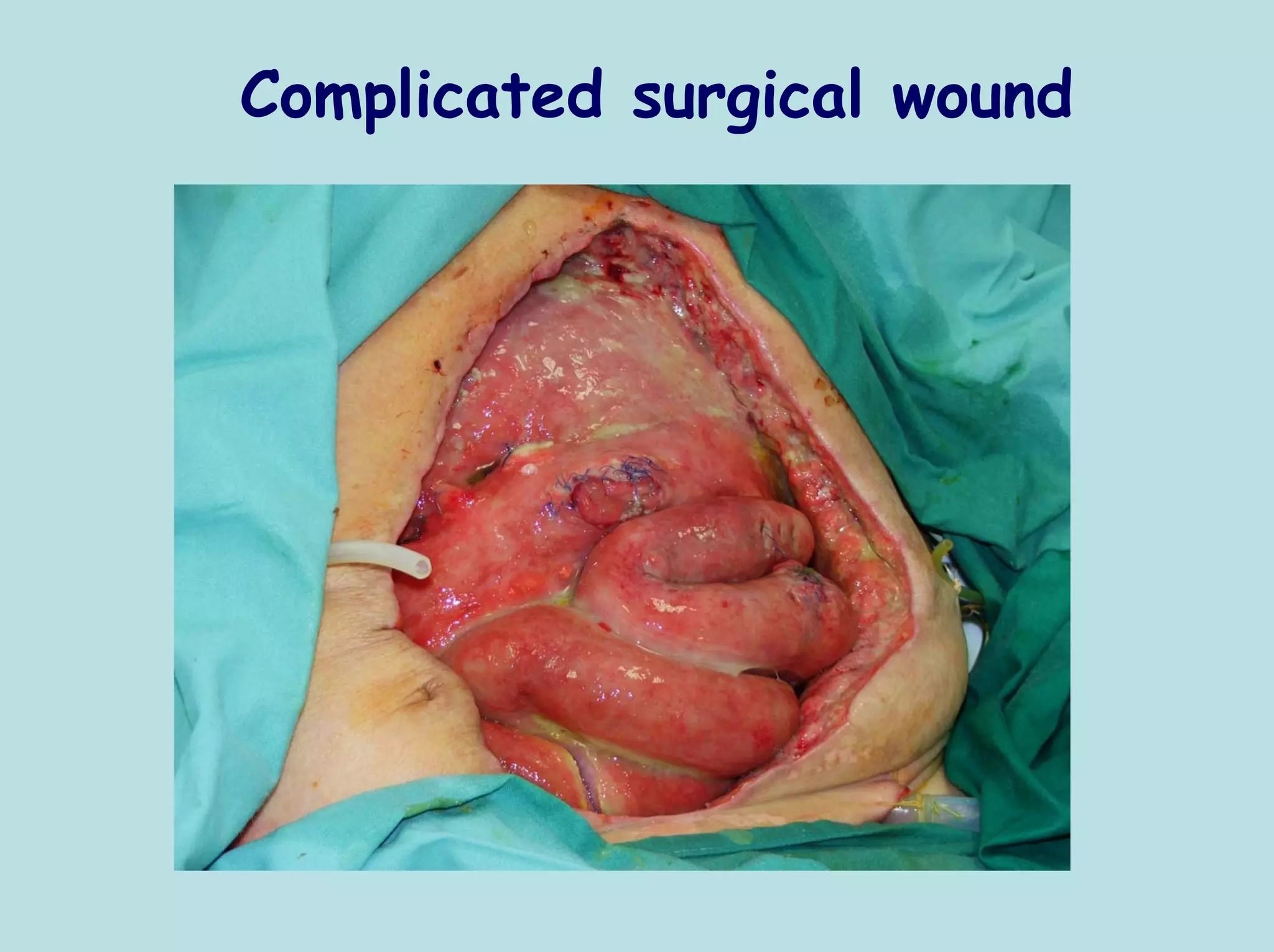 Complicated surgical wound
 