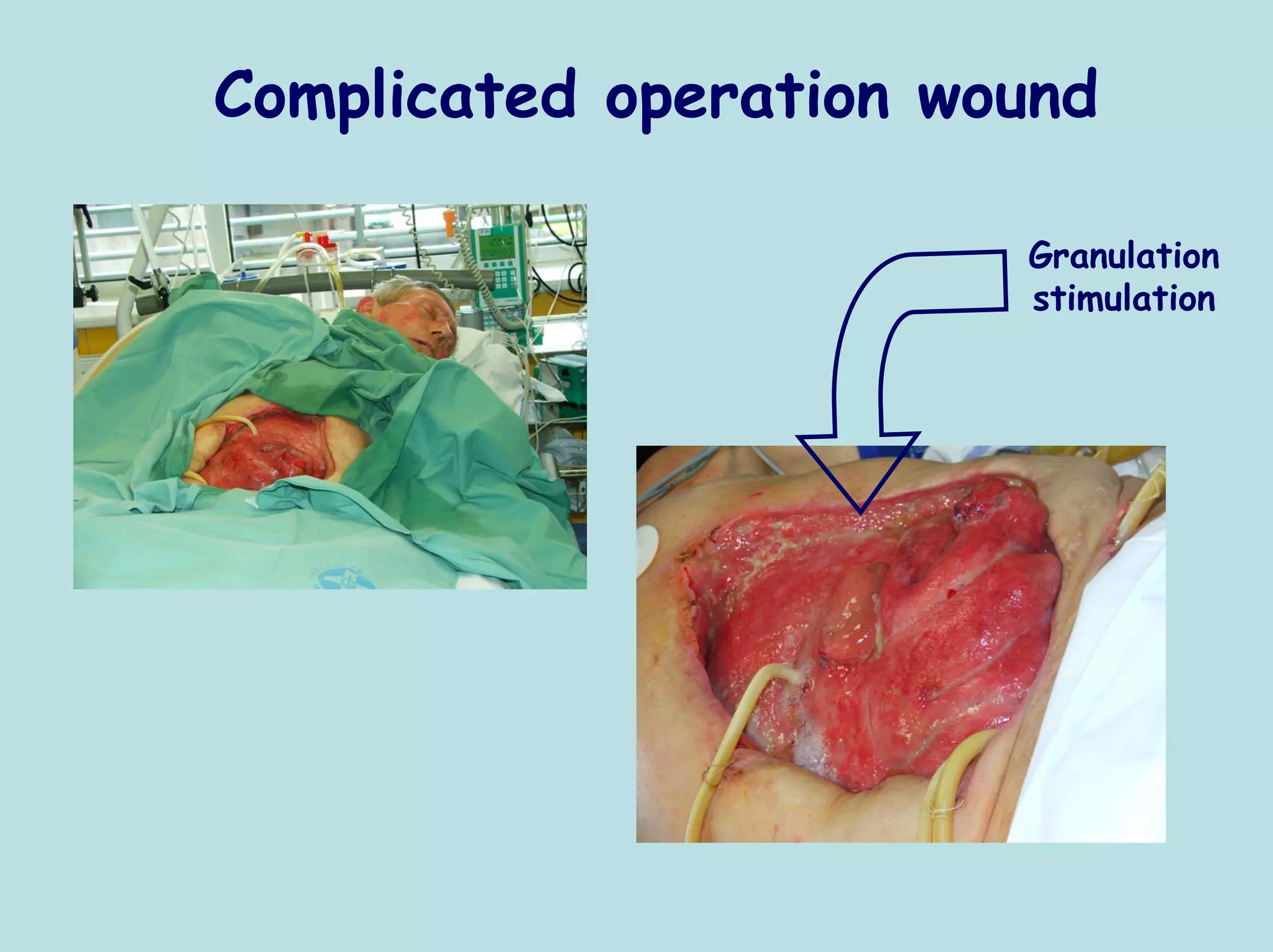 Complicated operation wound

                        Granulation
                        stimulation
 