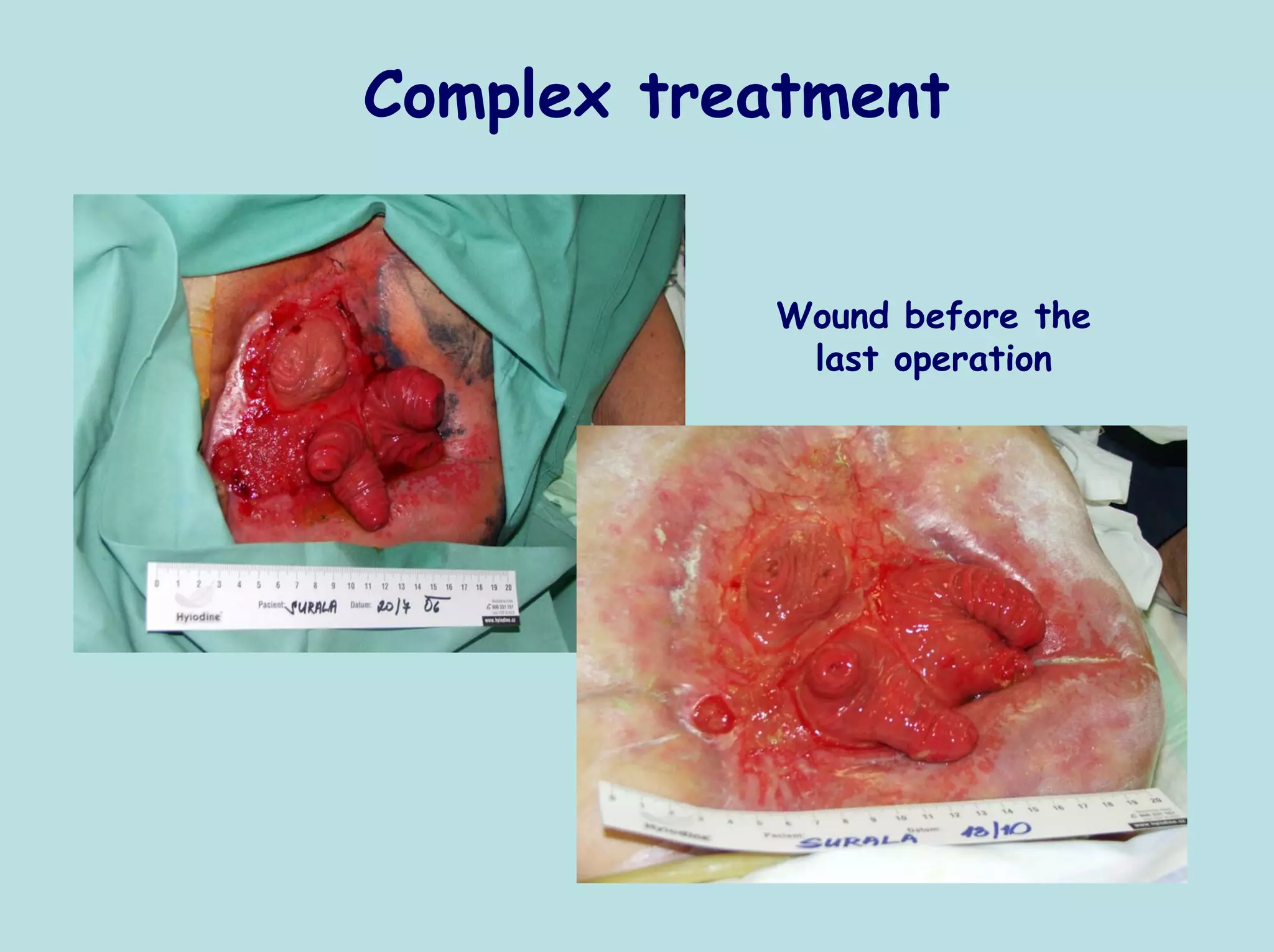 Complex treatment


           Wound before the
            last operation
 
