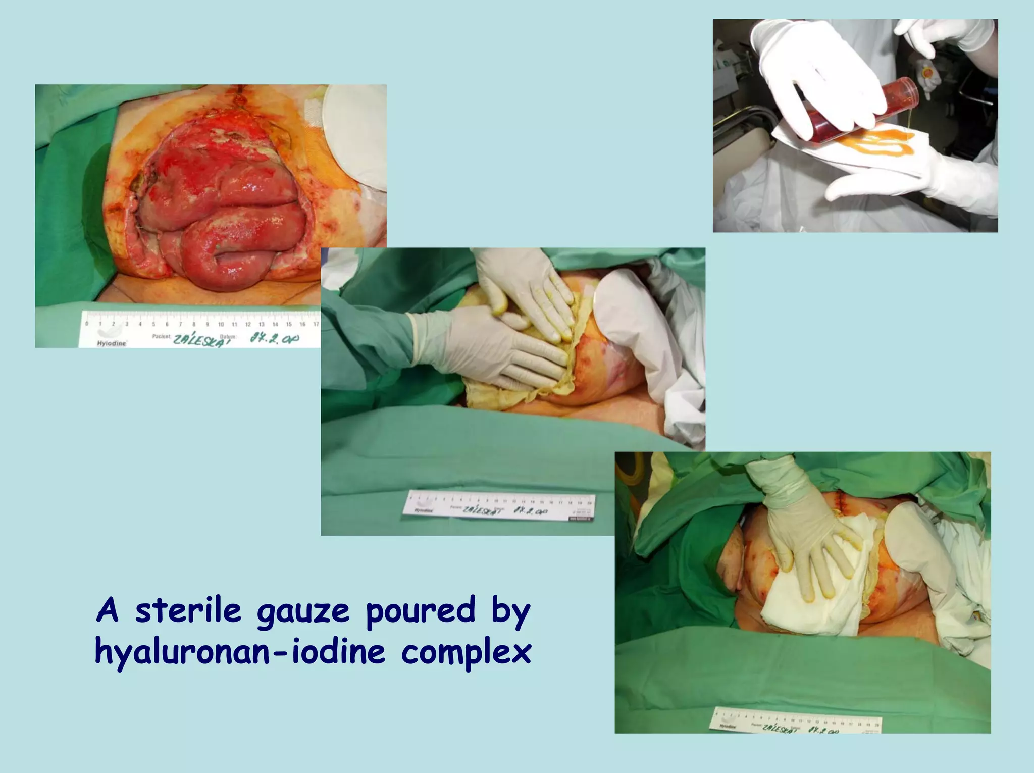 A sterile gauze poured by
hyaluronan-iodine complex
 