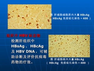 图 肝细胞细胞质内大量 HBsAg  （ HBsAg 免疫组化染色 ×400 ） 图 肝细胞核内大量 HBcAg  （ HBcAg  免疫组化染色 ×400   ） 组织中 HBV 标志物 检测肝组织中 HBsAg 、 HBcAg 及 HBV DNA ，可辅助诊断及评价抗病毒药物的疗效。 
