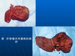 图  肝移植术所摘除的病肝 
