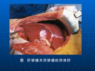 图  肝移植术所移植的供体肝 