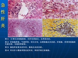 图 1  汇管区炎细胞浸润，向肝实质溢出。无界面炎症。 图 2  肝细胞肿胀、气球样变，均匀分布。血窦细胞反应活跃。肝细胞、库普弗细胞胆色素沉积，毛细胆管淤胆。 图 3  腺泡带显著炎症坏死，腺泡内炎症活跃。 图 4  终末肝小静脉周围炎症坏死，网状纤维支架塌陷。 急 性 肝 炎 