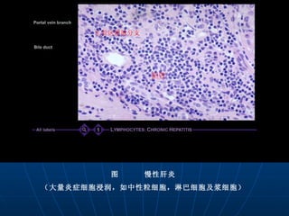 汇管区静脉分支   图  慢性肝炎 （大量炎症细胞浸润，如中性粒细胞，淋巴细胞及浆细胞） 胆管   