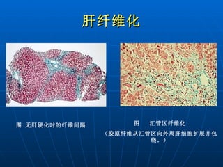 肝纤维化 图 无肝硬化时的纤维间隔 图  汇管区纤维化 （胶原纤维从汇管区向外周肝细胞扩展并包绕。） 