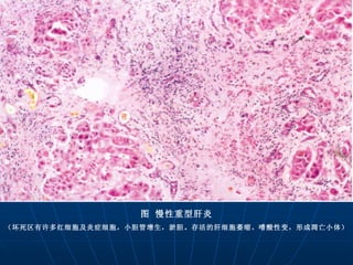 图 慢性重型肝炎 （坏死区有许多红细胞及炎症细胞，小胆管增生，淤胆。存活的肝细胞萎缩、嗜酸性变，形成凋亡小体） 