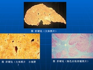 图 肝硬化（大体照片） 图 肝硬化（大体照片  小视野） 图 肝硬化（染色后低倍镜照片） 