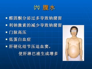 ㈥  腹水   醛固酮分泌过多导致钠潴留 利钠激素的减少导致钠潴留 门脉高压 低蛋白血症 肝硬化结节压迫血窦， 使肝淋巴液生成增多 