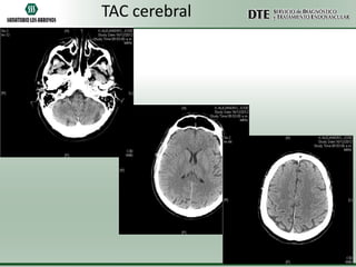 TAC cerebral

 