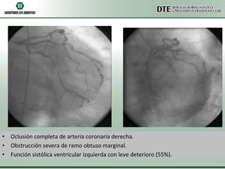 • Oclusión completa de arteria coronaria derecha.
• Obstrucción severa de ramo obtuso marginal.
• Función sistólica ventricular izquierda con leve deterioro (55%).

 