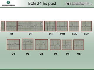 ECG 24 hs post

DI

V1

DII

V2

DIII

V3

aVR

V4

aVL

V5

aVF

V6

 