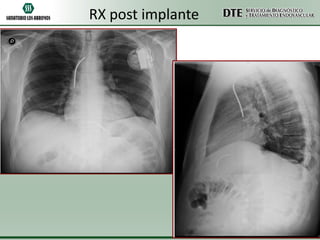 RX post implante

 