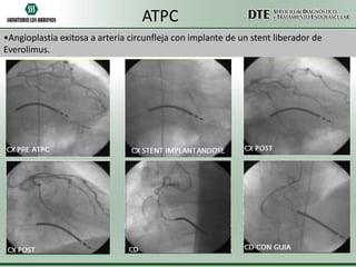 ATPC
•Angioplastia exitosa a arteria circunfleja con implante de un stent liberador de
Everolimus.

 