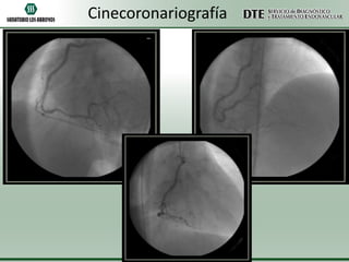 Cinecoronariografía

 
