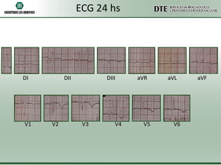 ECG 24 hs

DI

V1

DII

V2

DIII

V3

V4

aVR

V5

aVL

V6

aVF

 