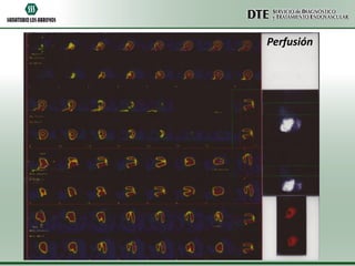 Perfusión

 