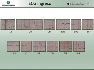 ECG ingreso

DI

DII

V1

V2

DIII

V3

aVR

V4

V5

aVL

V6

aVF

 