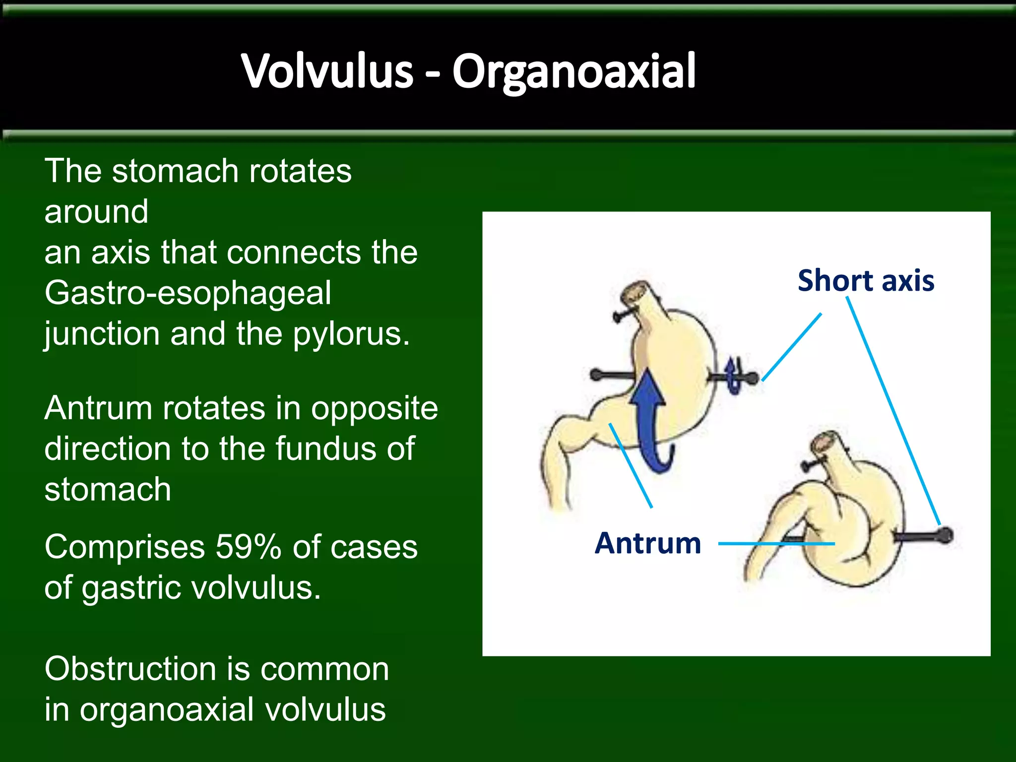The stomach rotates
around
an axis that connects the
Gastro-esophageal
junction and the pylorus.
Antrum rotates in opposite
direction to the fundus of
stomach
Comprises 59% of cases
of gastric volvulus.
Obstruction is common
in organoaxial volvulus
Short axis
Antrum
 