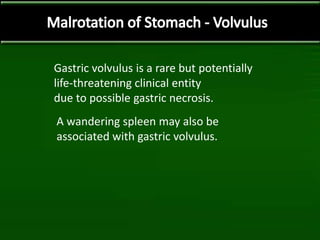 Gastric volvulus is a rare but potentially
life-threatening clinical entity
due to possible gastric necrosis.
A wandering spleen may also be
associated with gastric volvulus.
 