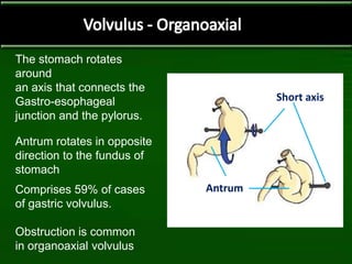 The stomach rotates
around
an axis that connects the
Gastro-esophageal
junction and the pylorus.
Antrum rotates in opposite
direction to the fundus of
stomach
Comprises 59% of cases
of gastric volvulus.
Obstruction is common
in organoaxial volvulus
Short axis
Antrum
 