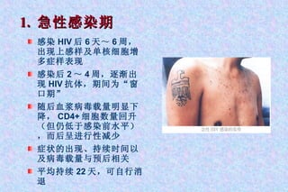 1.  急性感染期 感染 HIV 后 6 天～ 6 周，出现上感样及单核细胞增多症样表现 感染后 2 ～ 4 周，逐渐出现 HIV 抗体，期间为“窗口期” 随后血浆病毒载量明显下降， CD4+ 细胞数量回升（但仍低于感染前水平），而后呈进行性减少 症状的出现、持续时间以及病毒载量与预后相关 平均持续 22 天，可自行消退 