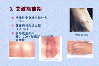3.  艾滋病前期 持续性全身淋巴结肿大 (PGL) 艾滋病相关综合征（ ARC ） 病毒载量开始上升， CD4+ 细胞减少速度明显加快 PGL 综合征 