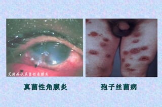 孢子丝菌病 真菌性角膜炎 