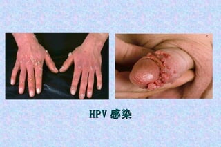 HPV 感染 