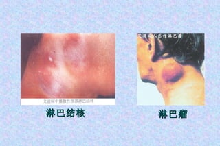 淋巴结核 淋巴瘤 