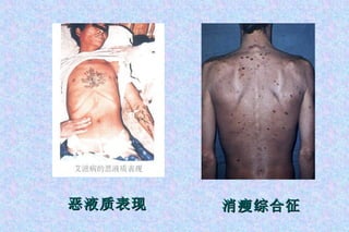 恶液质表现 消瘦综合征 