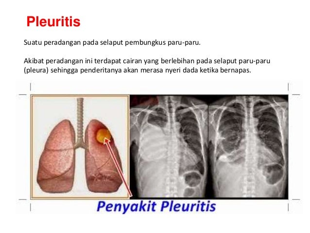 Peradangan Pada Selaput Pembungkus Paru Paru Disebut Sebutkan Mendetail
