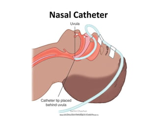 Nasal Catheter
Sachin Chauhan
sachu.chauhan@gmail.com
 
