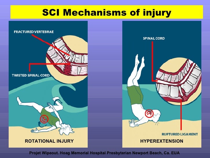 Spinal Cord Immobilization in Aquatic Environment