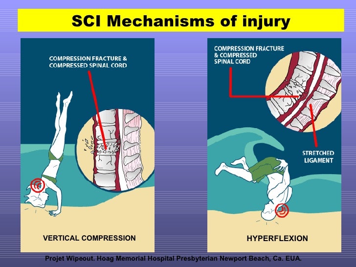 Spinal Cord Immobilization in Aquatic Environment