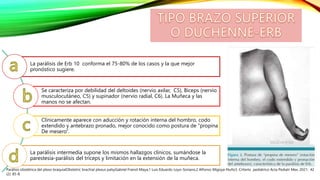 La parálisis de Erb 10 conforma el 75-80% de los casos y la que mejor
pronóstico sugiere.
Se caracteriza por debilidad del deltoides (nervio axilar, C5), Bíceps (nervio
musculocutáneo, C5) y supinador (nervio radial, C6). La Muñeca y las
manos no se afectan.
Clínicamente aparece con aducción y rotación interna del hombro, codo
extendido y antebrazo pronado, mejor conocido como postura de “propina
De mesero”.
La parálisis intermedia supone los mismos hallazgos clínicos, sumándose la
parestesia-parálisis del tríceps y limitación en la extensión de la muñeca.
Parálisis obstétrica del plexo braquialObstetric brachial plexus palsyGabriel Fraind-Maya,1 Luis Eduardo Loyo-Soriano,2 Alfonso Migoya-Nuño3. CrIterIo pediátrico Acta Pediatr Mex. 2021; 42
(2): 85-8.
 