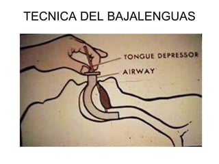 TECNICA DEL BAJALENGUAS
 