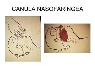 CANULA NASOFARINGEA
 