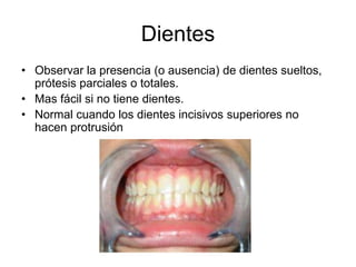 Dientes
• Observar la presencia (o ausencia) de dientes sueltos,
prótesis parciales o totales.
• Mas fácil si no tiene dientes.
• Normal cuando los dientes incisivos superiores no
hacen protrusión
 