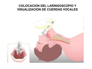 COLOCACION DEL LARINGOSCOPIO Y
VISUALIZACION DE CUERDAS VOCALES
 