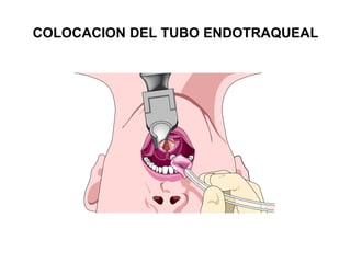 COLOCACION DEL TUBO ENDOTRAQUEAL
 